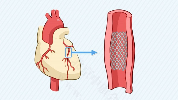 心脏支架.jpg